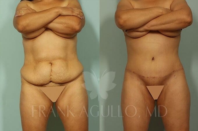 Mommy Makeover Before and After 7