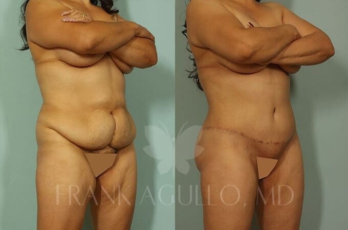 Mommy Makeover Before and After 8