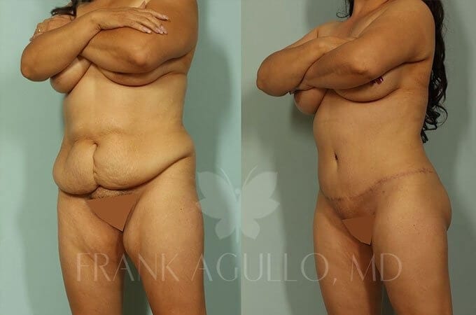 Mommy Makeover Before and After 9