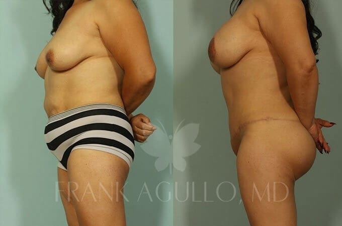 Mommy Makeover Before and After 2