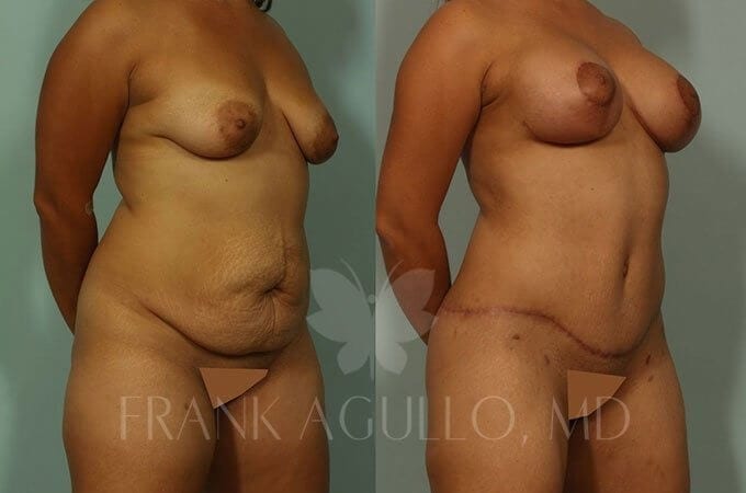 Mommy Makeover Before and After 2