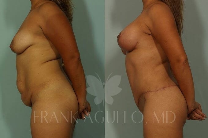 Mommy Makeover Before and After 3