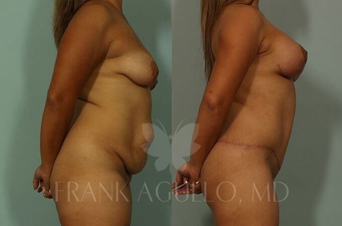 Mommy Makeover Before and After 4