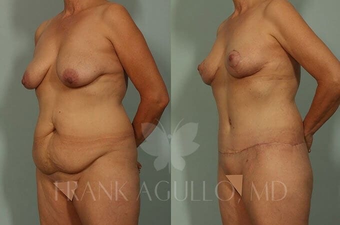 Mommy Makeover Before and After 2