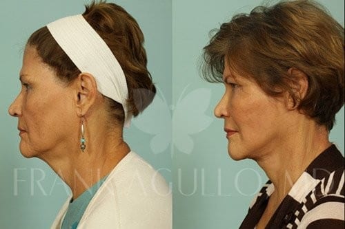 Neck Lift Before and After 14