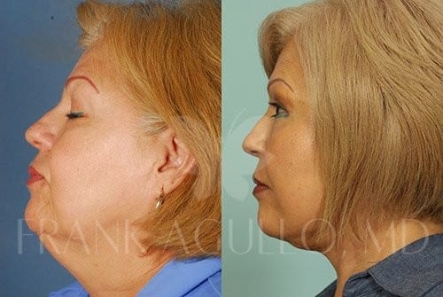 Neck Lift Before and After 13