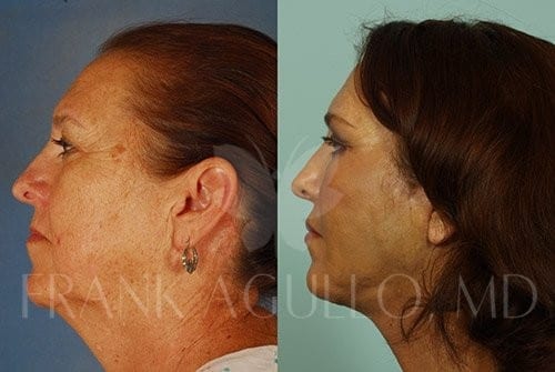 Neck Lift Before and After 12