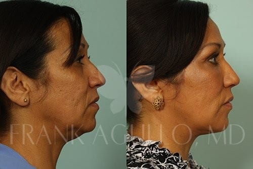 Neck Lift Before and After 11