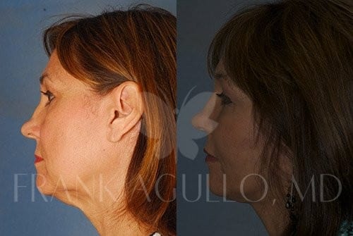 Neck Lift Before and After 10