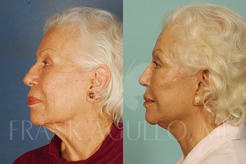 Neck Lift Before and After 9