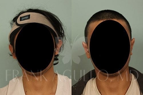 Otoplasty Before and After 4