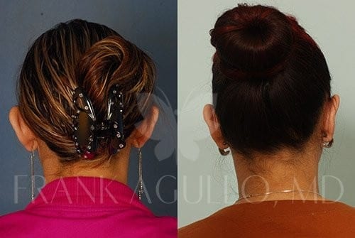 Otoplasty Before and After 2