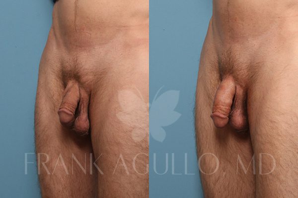 Penis Enlargement Before and After 2