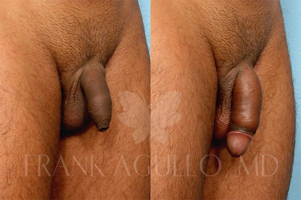 Penis Enlargement Before and After 2