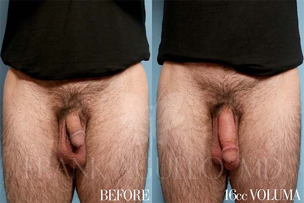 Penis Enlargement Before and After 4