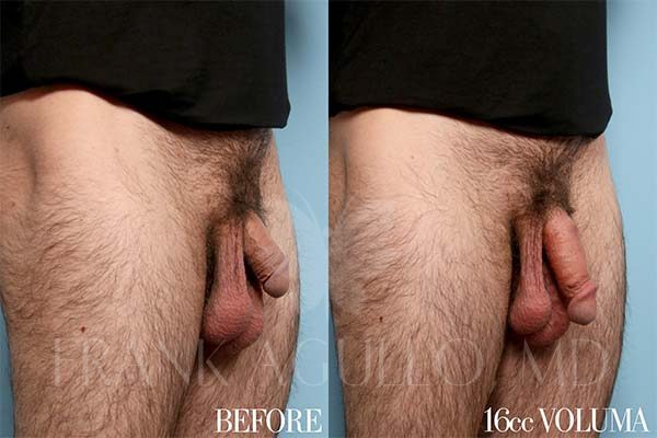 Penis Enlargement Before and After 3