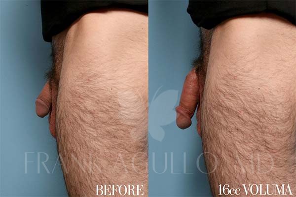 Penis Enlargement Before and After 2