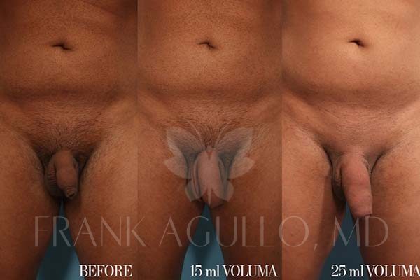 Penis Enlargement Before and After 2