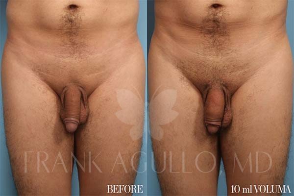 Penis Enlargement Before and After 2