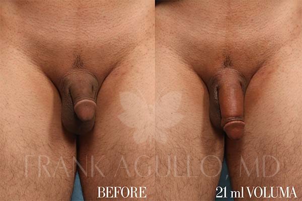 Penis Enlargement Before and After 1