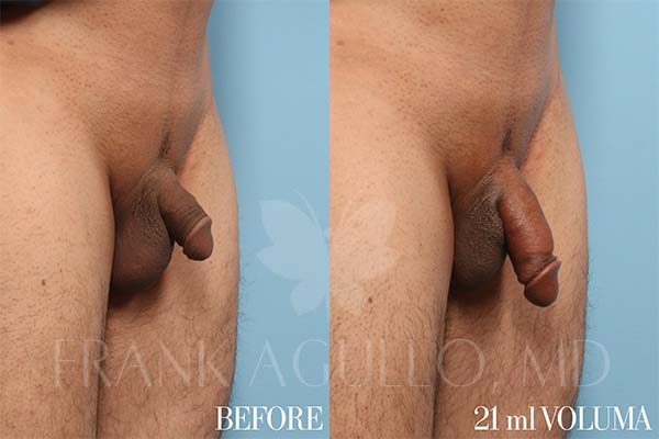 Penis Enlargement Before and After 3