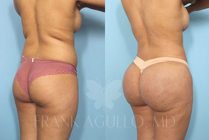 Brazilian Butt Lift Before and After 9