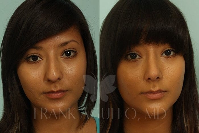 Rhinoplasty Before and After 17