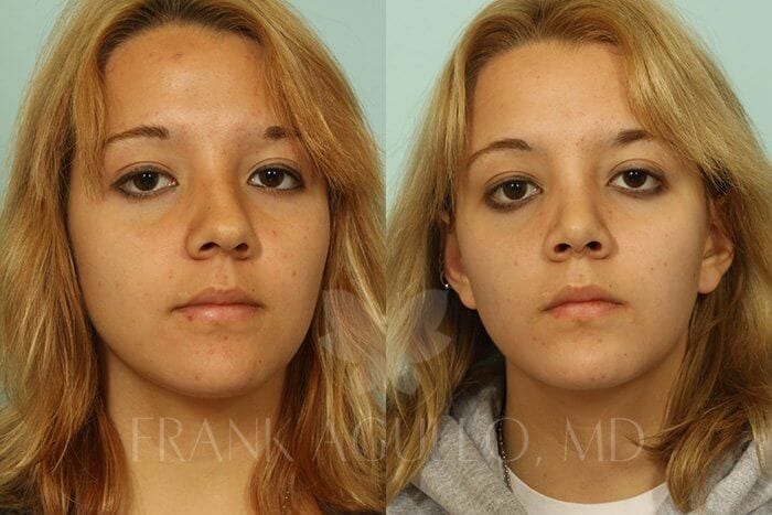 Rhinoplasty Before and After 16