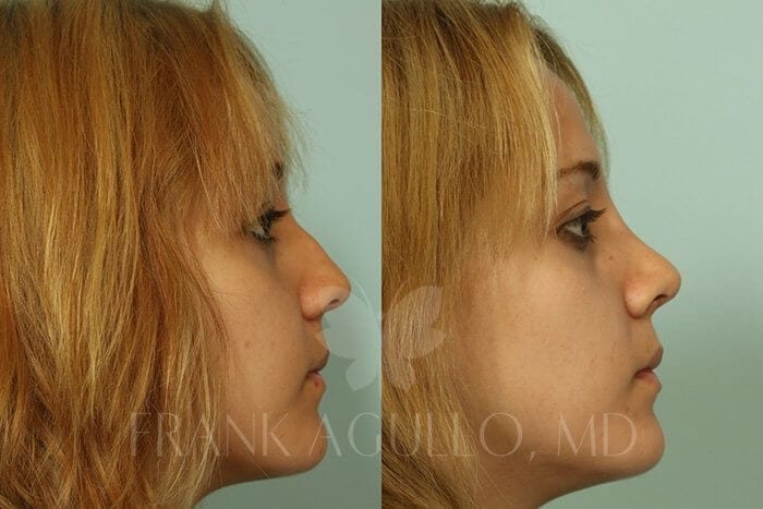 Rhinoplasty Before and After 2