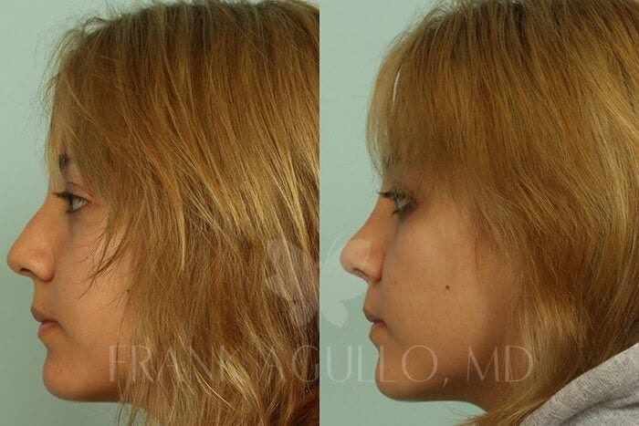 Rhinoplasty Before and After 3