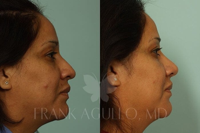 Rhinoplasty Before and After 2