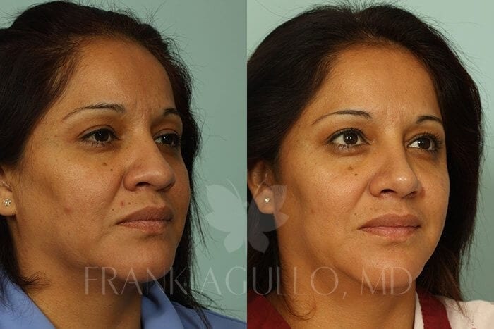 Rhinoplasty Before and After 3