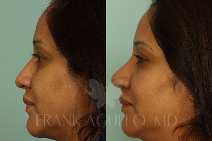 Rhinoplasty Before and After 4