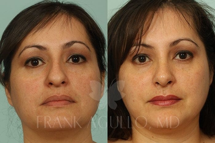 Face Before and After 10