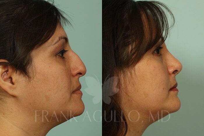 Rhinoplasty Before and After 2