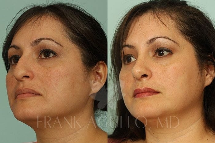 Rhinoplasty Before and After 3