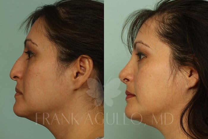 Rhinoplasty Before and After 4
