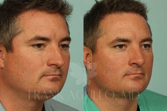 Rhinoplasty Before and After 4