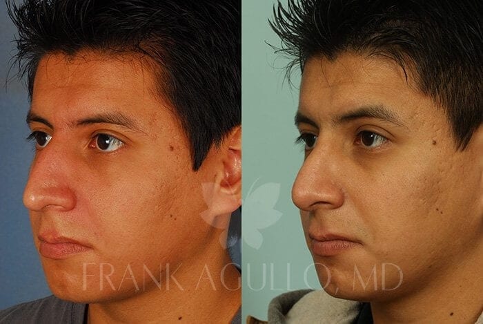 Rhinoplasty Before and After 12