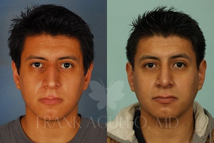 Rhinoplasty Before and After 2