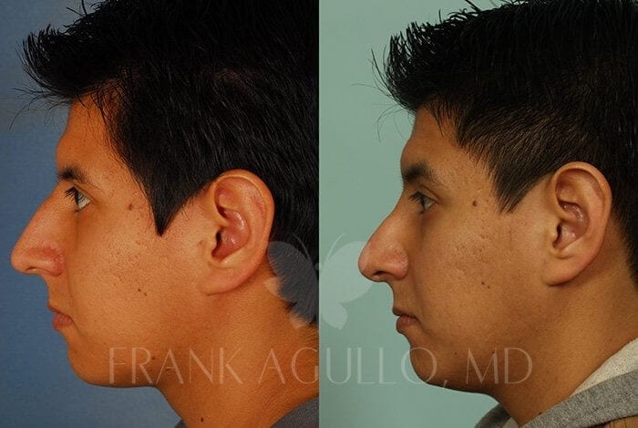 Rhinoplasty Before and After 3