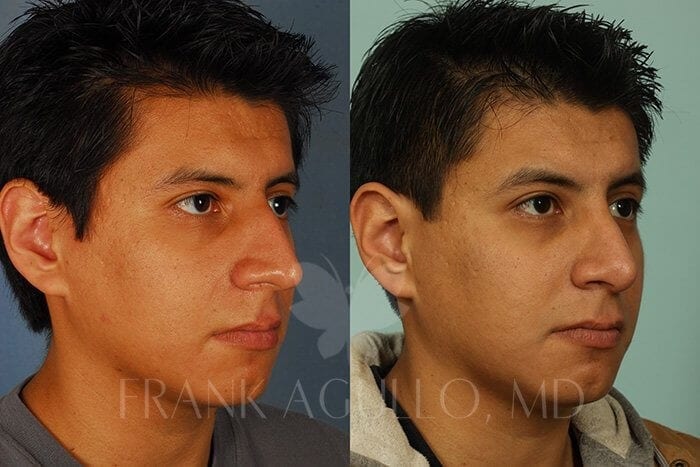 Rhinoplasty Before and After 4
