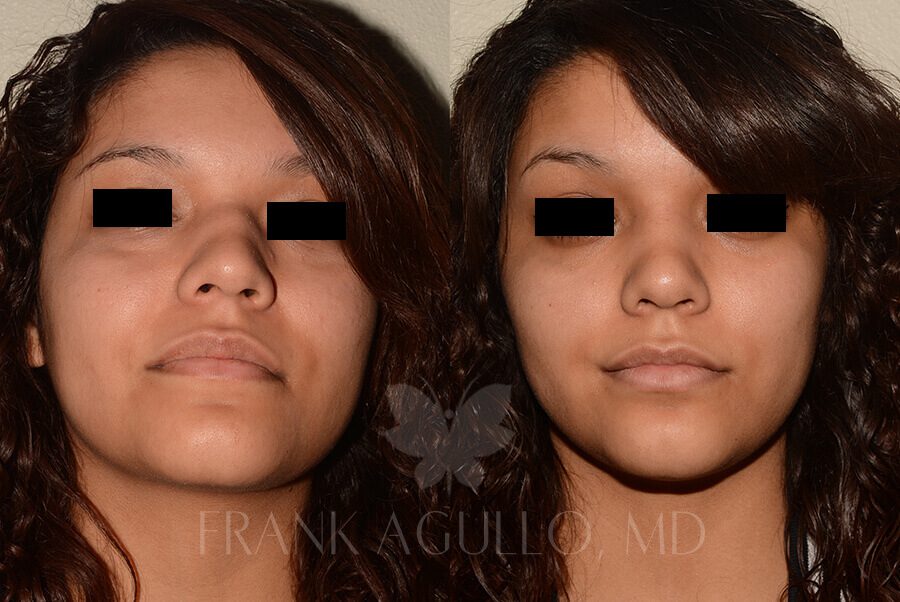 Rhinoplasty Before and After 6