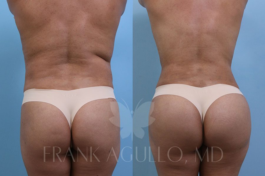 RibX Rib Repositioning Before and After 4