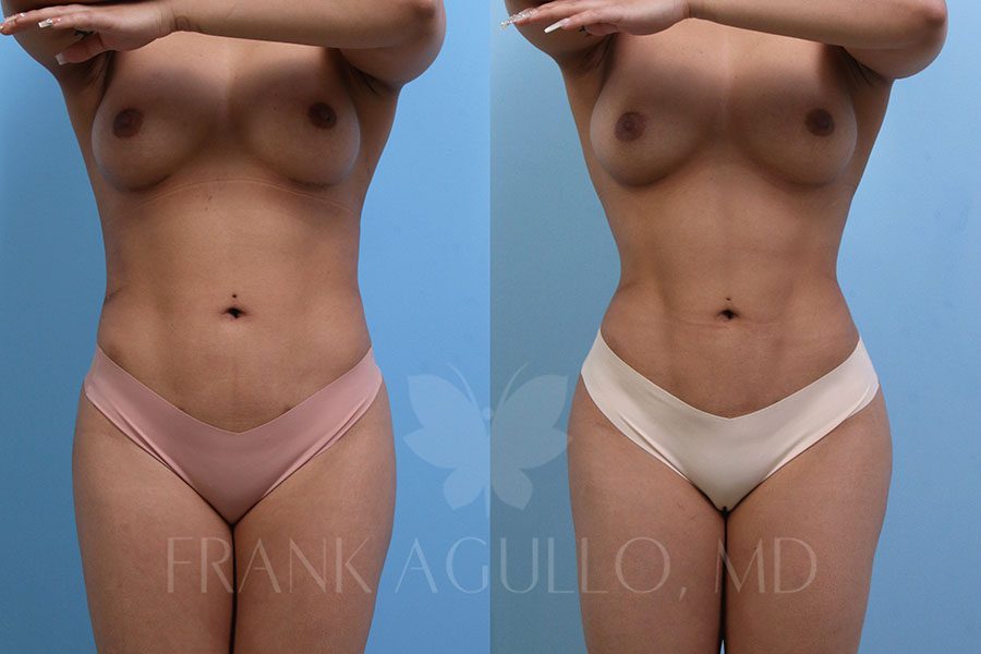 RibX Rib Repositioning Before and After 5