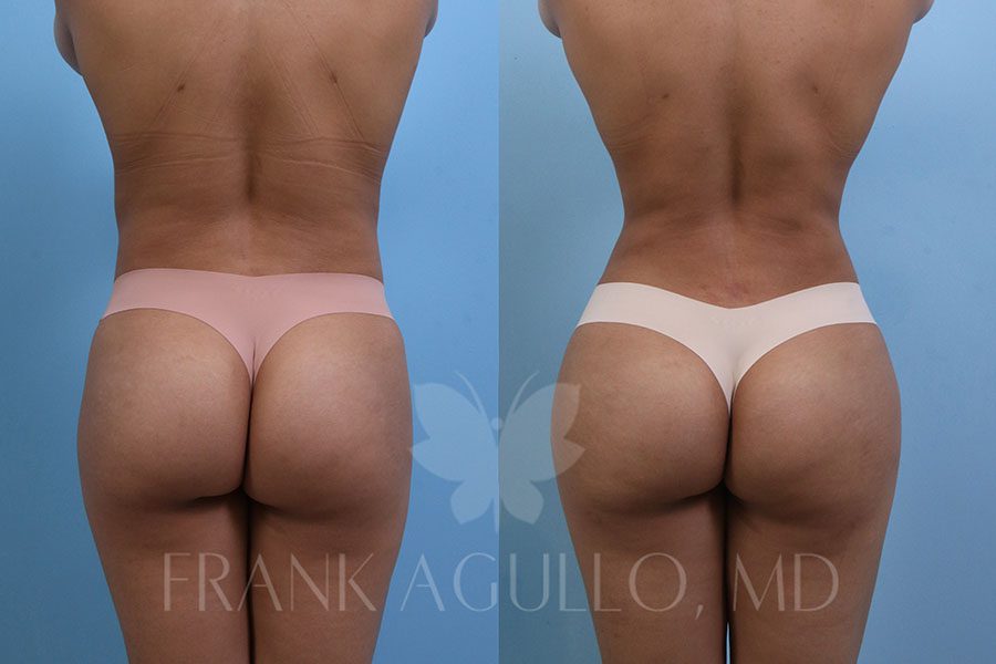 RibX Rib Repositioning Before and After 3