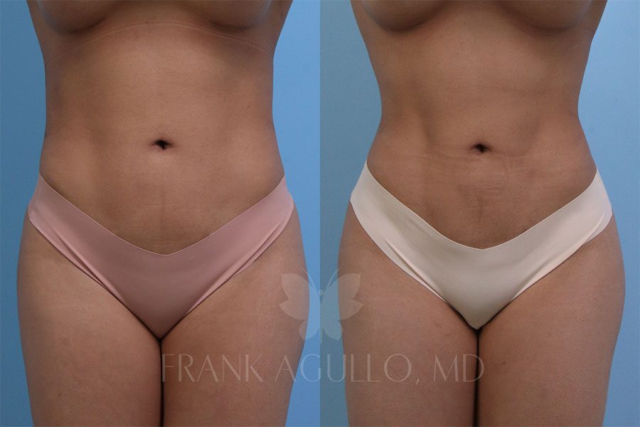 RibX Rib Repositioning Before and After 2