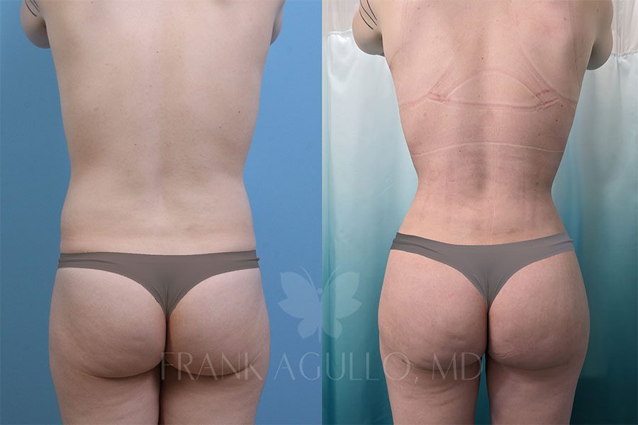 RibX Rib Repositioning Before and After 1