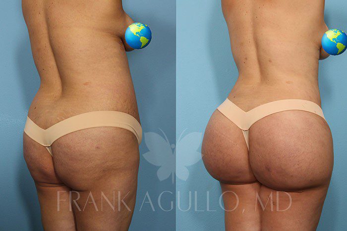 Brazilian Butt Lift Before and After 8