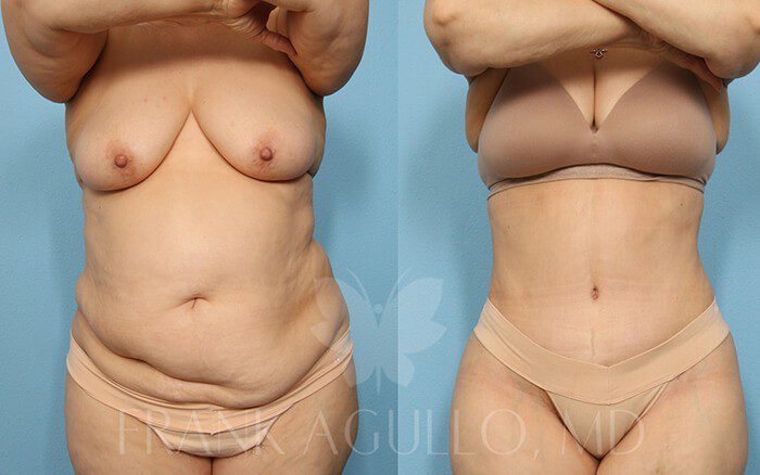 Tummy Tuck Before and After 1